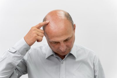 Alles wat je moet weten over kaalheid en finasteride